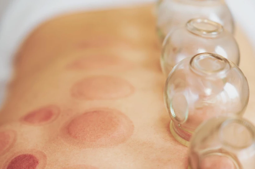 Masaż bańką chińską – naturalny sposób na rozluźnienie mięśni i poprawę kondycji skóry