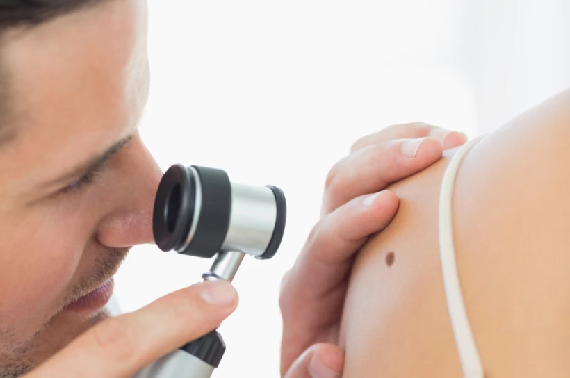 Dermatoskopia – szybkie badanie, które może uratować zdrowie